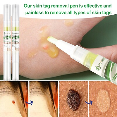#ad 2 PCS Skin Tag Remover Pen Skin Tag Mole Wart Dark Spot Remover Painless amp; Safe $8.89