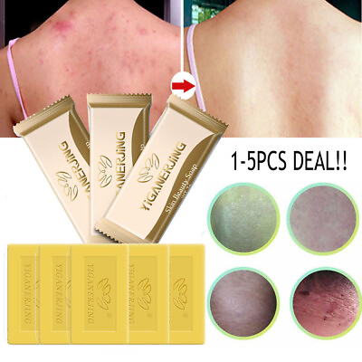 #ad 5 1PCS Sulfur Soap Anti Fungal Scabies Acne Treatment Itching Handmade Bath Soap $7.73