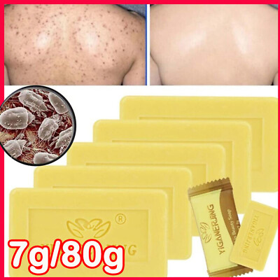#ad 5 10x Sulfur Soap Mite Remover Soap Anti Fungal Scabies Acne Treatment Bath Soap $27.75