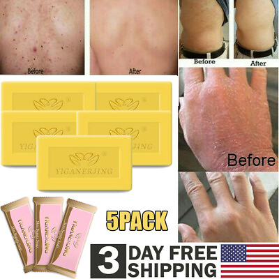 #ad 5x Sulfur Soap Skin Cleaning Acne Seborrhea Anti Fungus Bath Soap Anti mite 7g $11.38